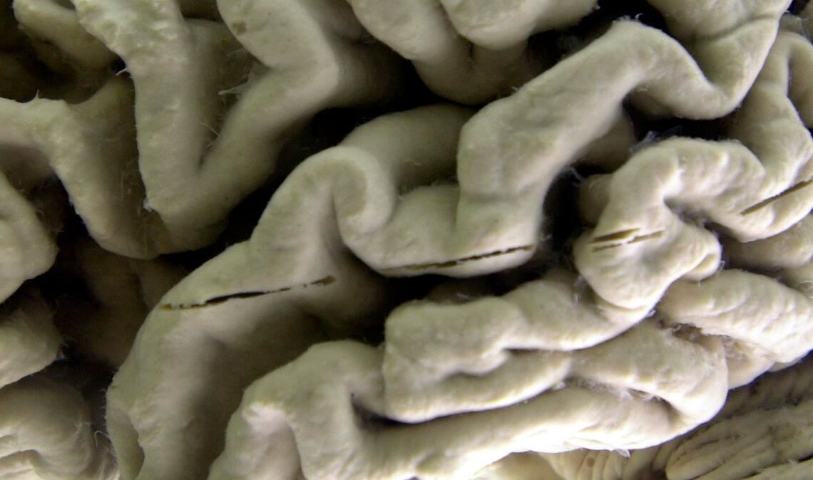 Das Gehirn eines Alzheimer-Patienten zeigt tiefe Furchen. (Illustration)