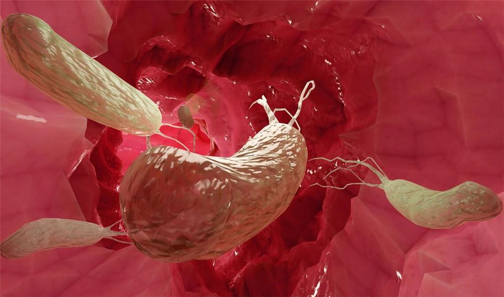 Das Magenbakterium Helicobacter pylori kann Magengeschwüre und Krebs verursachen.