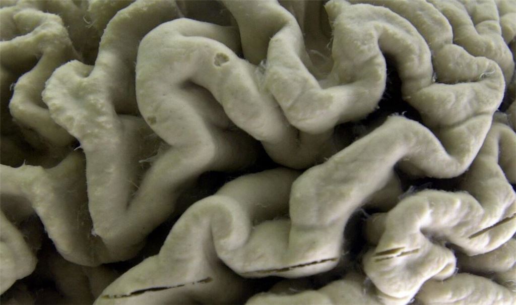 Der Antikörper Lecanemab richtet sich gegen Amyloid-Ablagerungen im Gehirn und soll dadurch den Verlauf der Krankheit in einem frühen Stadium verlangsamen.