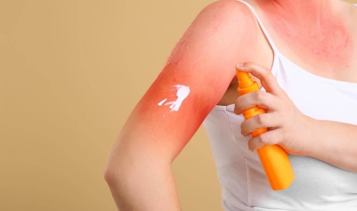 Der Sonnenbrand kann unterschiedliche Gründe haben.