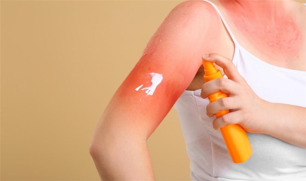 Der Sonnenbrand kann unterschiedliche Gründe haben.