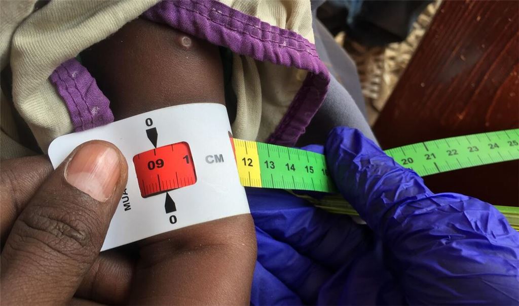 Ein Arzt misst im Sudan den Armumfang eines schwer unterernährten Babys (Archivbild)