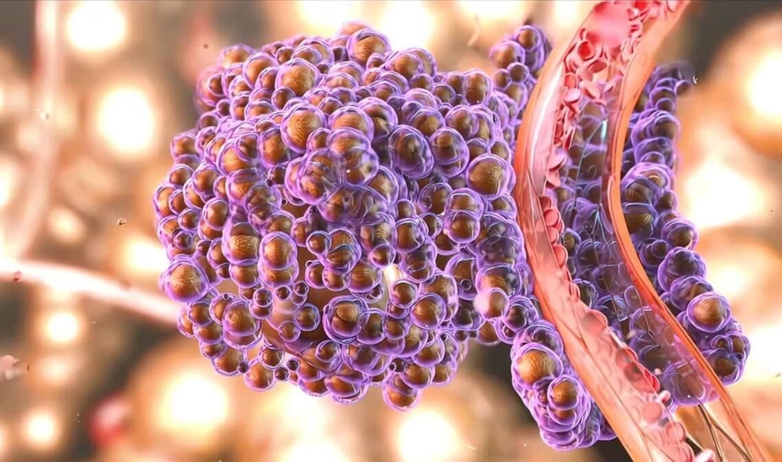 Ein Tumor streut Metastasen in verschiedene Regionen des Körpers.