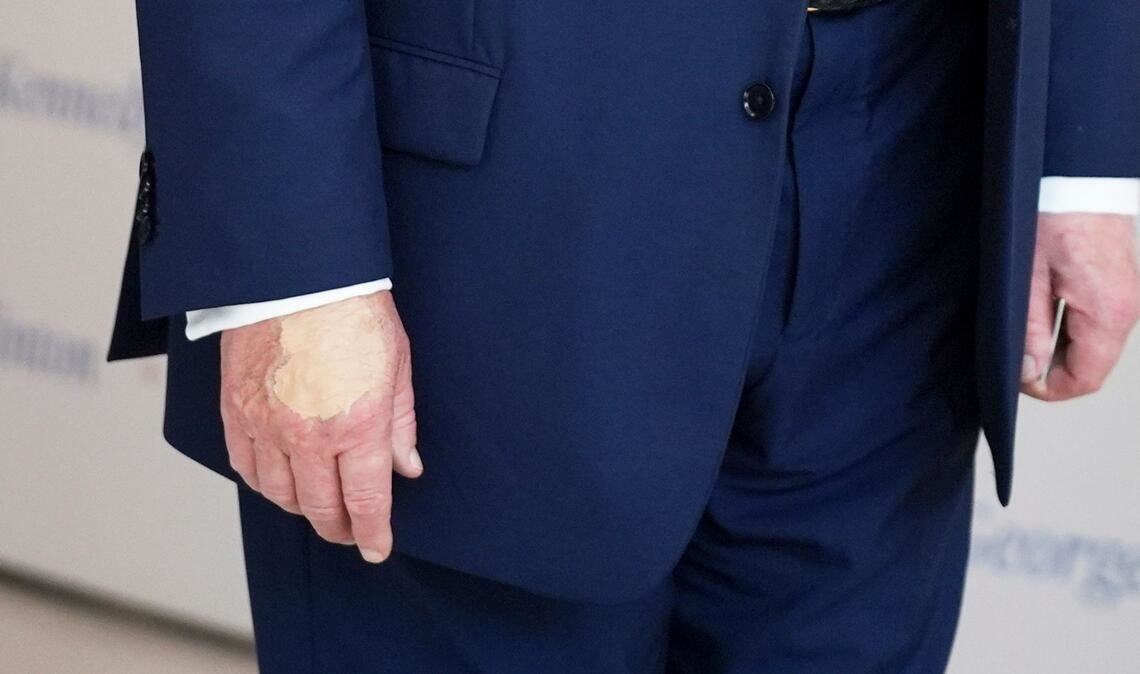 Für Trump ein unliebsames Thema: die überschminkte Hand (Archivbild).