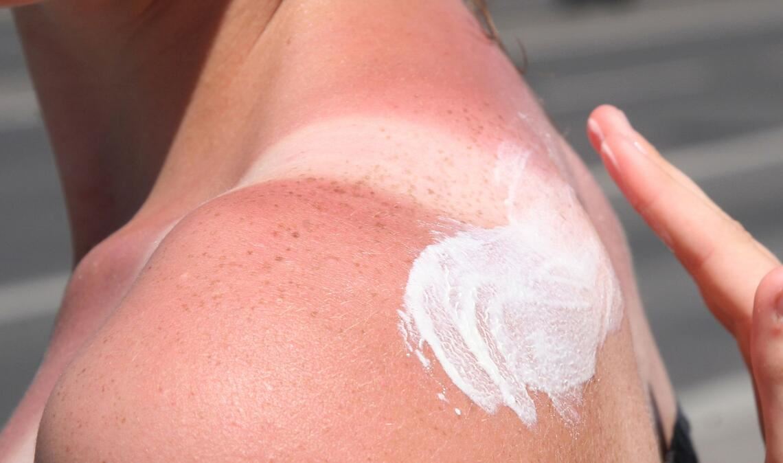 Hier kommt die Sonnencreme zu spät, die Haut ist schon verbrannt.