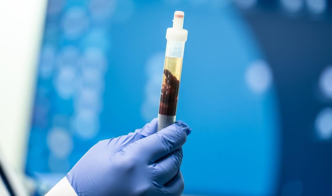 In Kalifornien konnte eine Pest-Infektion nachgewiesen werden