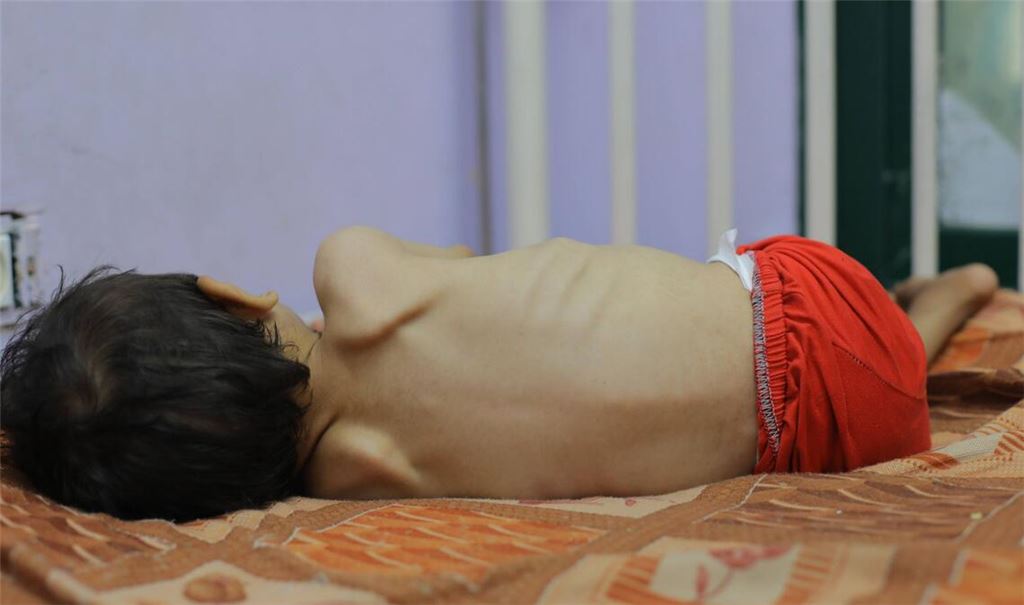 Kinder mit Mangelernährung in Gaza werden unter eingeschränkten Bedingungen behandelt.