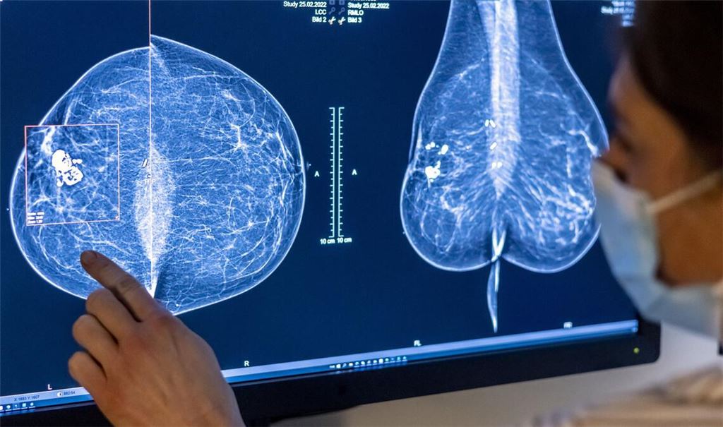 Medizinisches Personal untersucht mit einer Mammografie die Brust einer Frau auf Brustkrebs. Die Untersuchung soll bei der frühen Erkennung von Brustkrebs helfen.