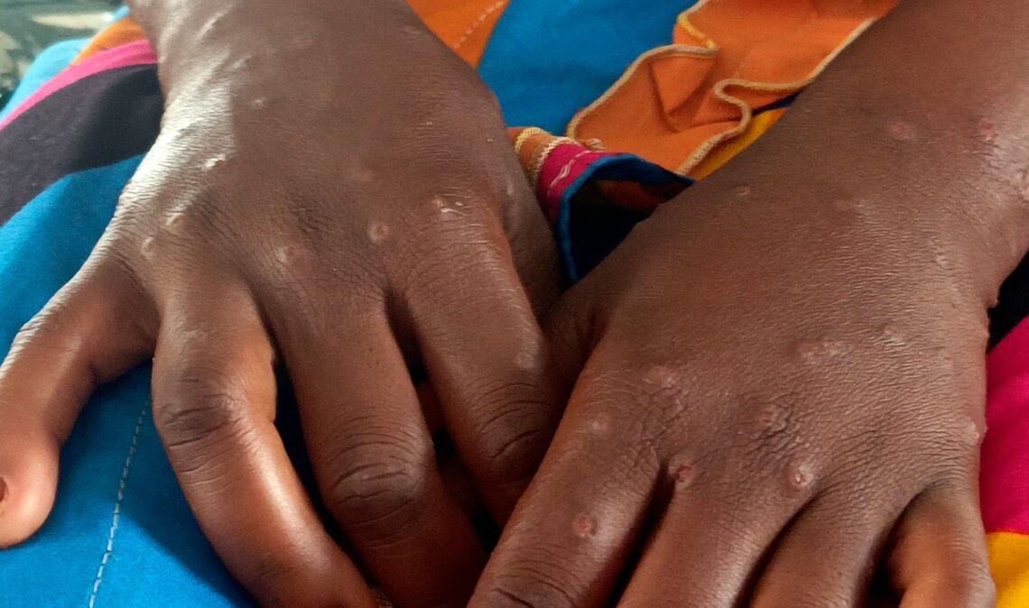 Mpox ist vor allem für kleine Kinder und immungeschwächte Menschen gefährlich (Archivbild)
