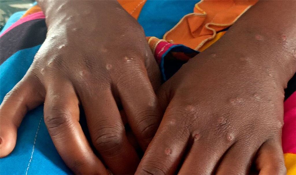 Mpox ist vor allem für kleine Kinder und immungeschwächte Menschen gefährlich (Archivbild)