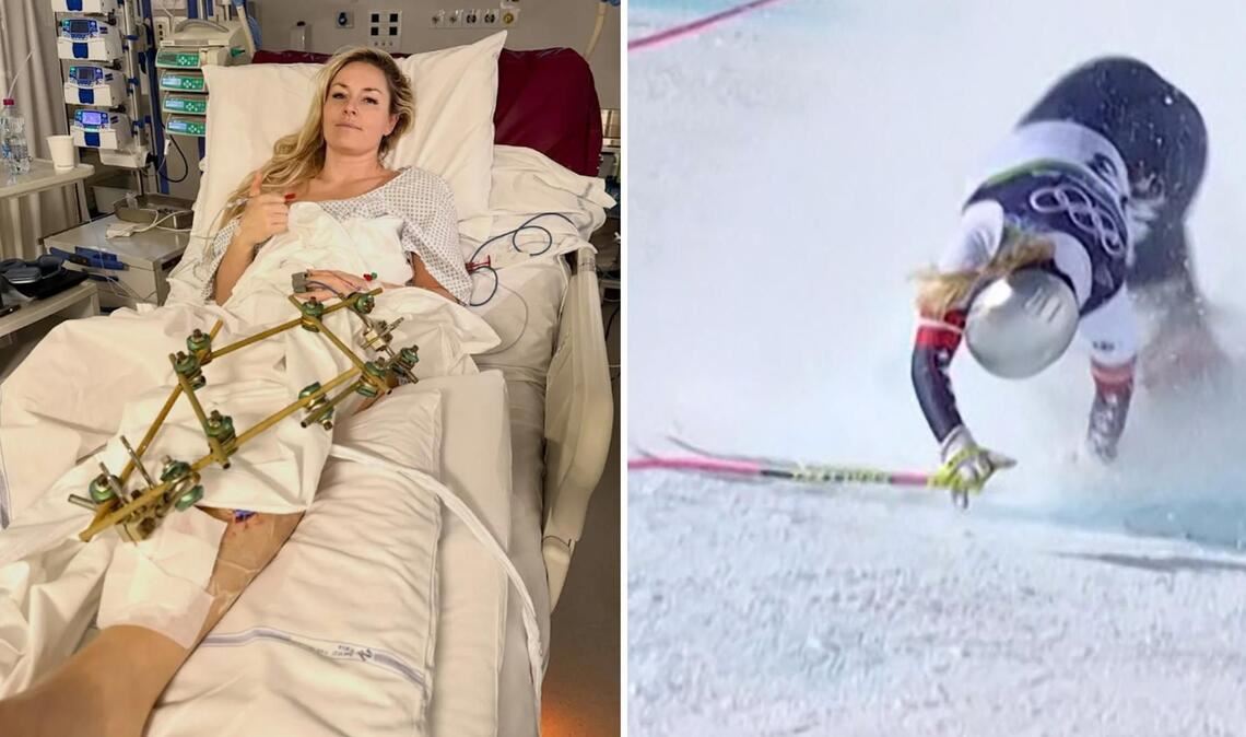 Nach ihrem Schienbeinbruch auf der Tofana liegt Lindsey Vonn mit einem „Fixateur externe“ in der Klinik.