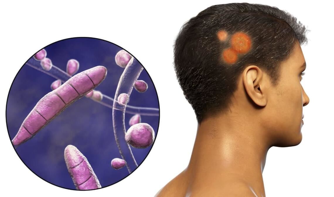 Spezielle Pilze, sogenannte Dermatophyten,  können Hautpilzerkrankung hervorrufen. Ist der Kopf betroffen, ist der Pilz Tinea capitis der Auslöser.