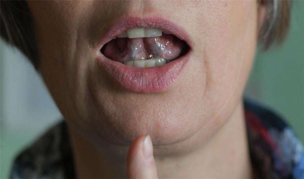 Stotternde Menschen können mit Hilfe von regelmäßigen Sprechübungen ihren Redefluss verbessern. (Symbolbild)