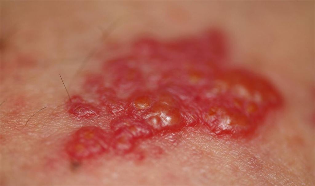 Verdacht auf Gürtelrose: Bei solchen rotgefärbten Bläschen auf der Haut, sollten Sie dringend zum Arzt gehen.