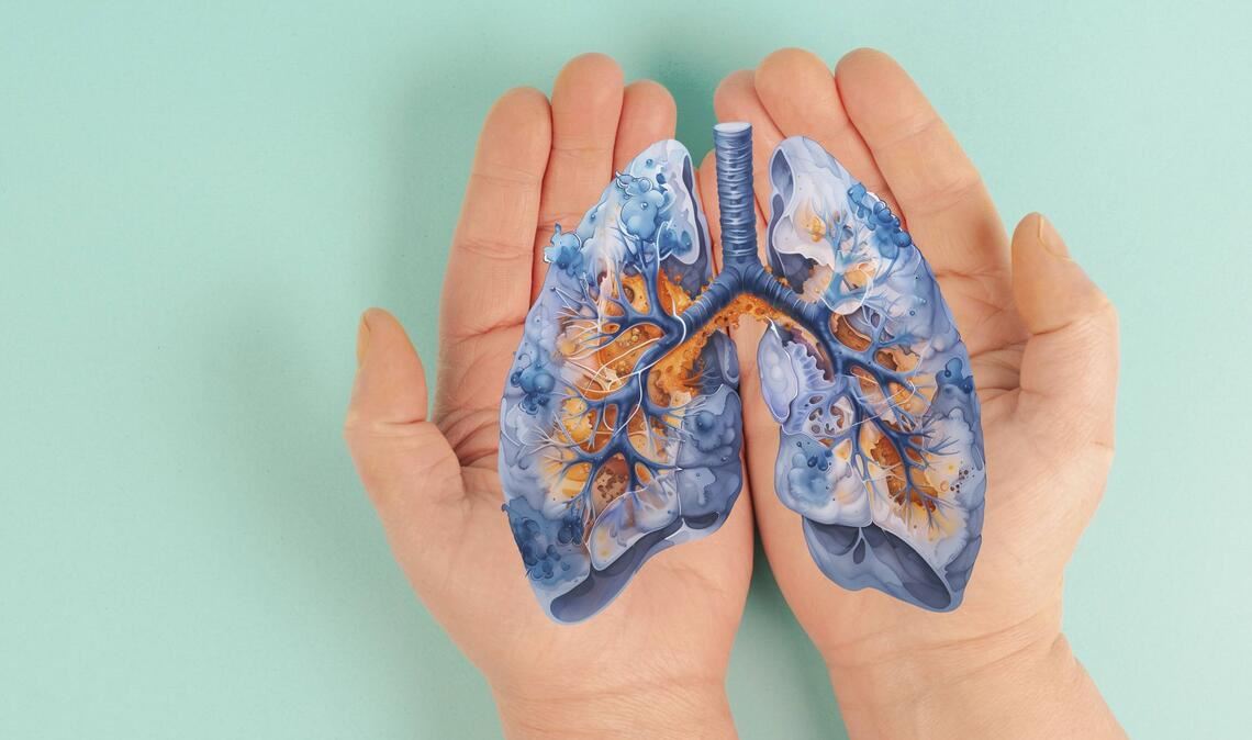 Virale Atemwegsinfektionen wie Grippe oder Covid-19 können gestreute Krebszellen in der Lunge reaktivieren und dadurch die Metastasenbildung fördern.