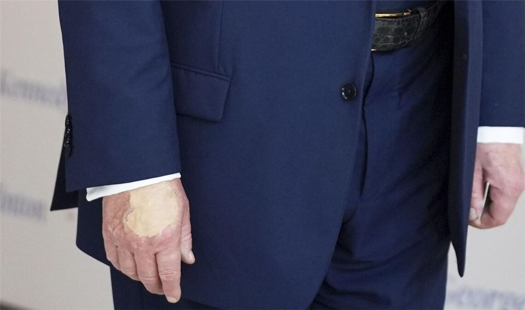 Wirklich nur vom vielen Händeschütteln? Auffällige Flecken auf Trumps Händen sorgen für Fragen.